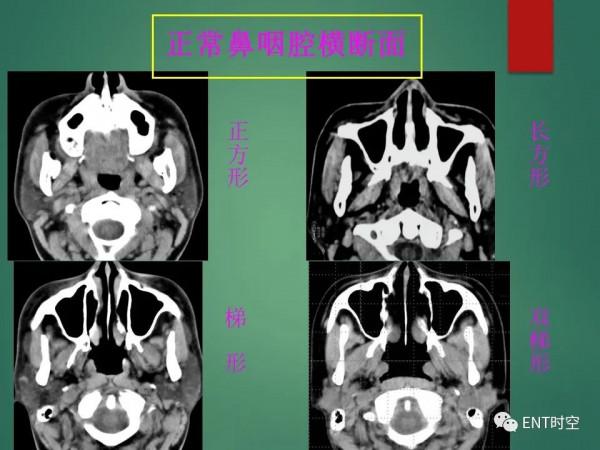 頭頸五官CT斷層解剖圖及常見病影像診斷