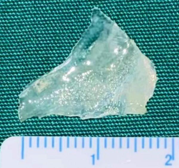 2歲男孩兩天不吃不喝，竟是因為喉嚨“遇刺”！多學科專家聯手“拆彈”