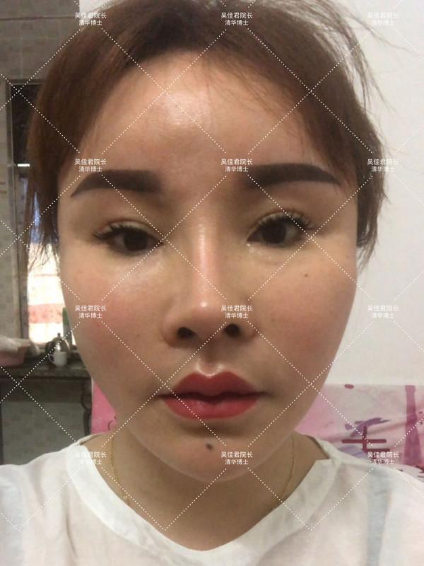 40多歲做小拉皮真實經歷,術後6個月效果很驚豔 40多歲做小拉皮真實經歷,術後6個月效果很驚豔