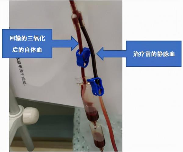 25年痛風病史，全身多處痛風石，疼痛難忍的痛風還能這麼治