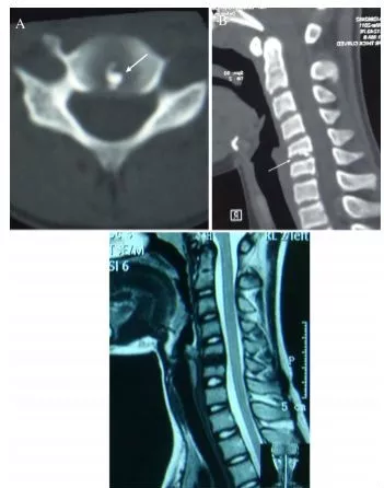 頸椎少見的3種鈣化性疾病 頸椎少見的3種鈣化性疾病