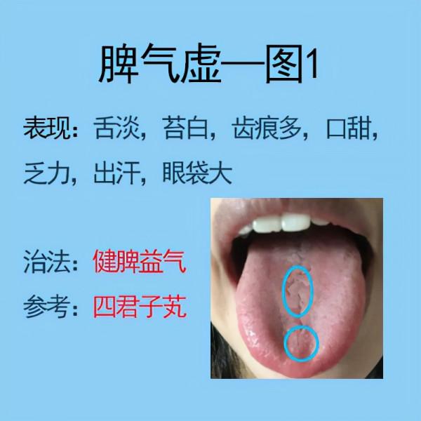 脾胃不好常見6種舌象，比如脾氣虛，脾陽虛等，後面有解決方法