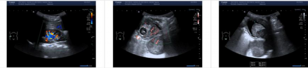 2歲萌娃突然排尿困難，兒童更應警惕這種腫瘤