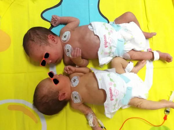 汨羅市人民醫院成功救治一對雙胎輸血綜合徵雙胞胎 汨羅市人民醫院成功救治一對雙胎輸血綜合徵雙胞胎