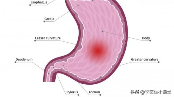 總是反酸燒心怎麼辦？三個小方法，幫你緩解胃食管返流