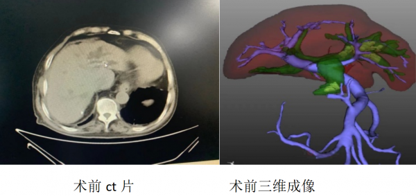 耄耋老人三戰膽道結石，醫務人員勇闖手術禁區，微創取石