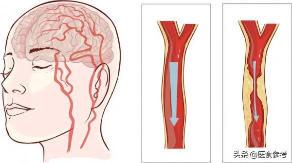 預防腦梗塞，達比加群和阿司匹林哪個更好？使用需要注意什麼？
