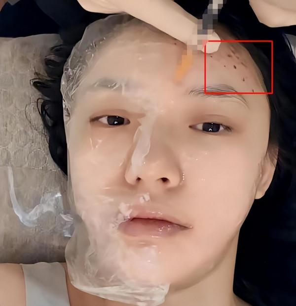 “星女郎”林允曬微整影片，針孔滲血珠，臉部浮腫，網友：太狠了