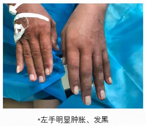 被“偷血的手”——罕見的“竊血綜合徵”