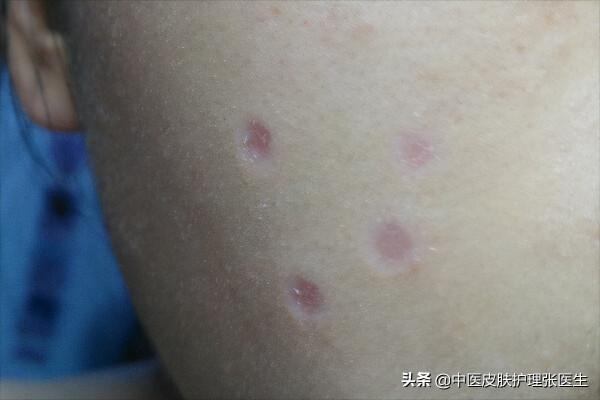 路邊很火的藥水點痣,一分鐘點好七天消除,面板科醫生有話想說 路邊很火的藥水點痣,一分鐘點好七天消除,面板科醫生有話想說