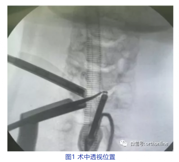 文獻梳理 脊柱後路內鏡治療脊髓型頸椎病