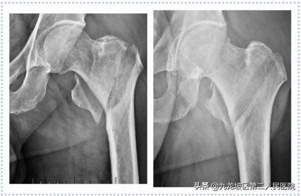 22張高畫質X線片!帶你看清胯骨骨折手術前後對比 22張高畫質X線片!帶你看清胯骨骨折手術前後對比