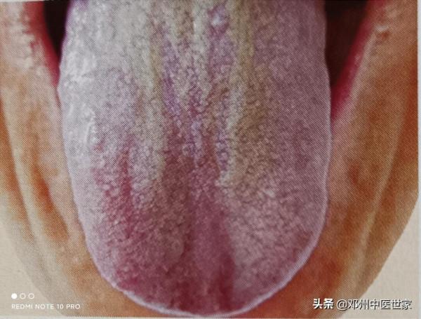 胃脘痞滿、溼熱阻胃的舌象