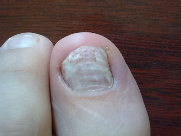 得了灰指甲,反覆發作難根治?一次性介紹7種藥,總有一款適合你 得了灰指甲,反覆發作難根治?一次性介紹7種藥,總有一款適合你