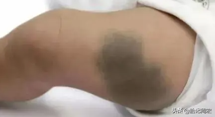 太田痣為什麼要治療? 太田痣為什麼要治療?