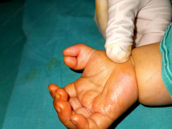 多指手術幾個月後,孩子哭個不停,媽媽扳開寶寶手後立馬送進醫院 多指手術幾個月後,孩子哭個不停,媽媽扳開寶寶手後立馬送進醫院