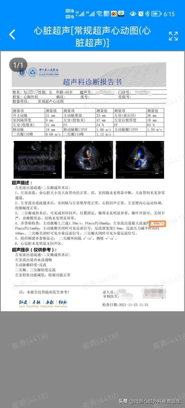 無可見疤痕的微創肥厚梗阻性心肌病手術 無可見疤痕的微創肥厚梗阻性心肌病手術