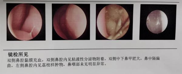 鼻阻、流膿?鼻息肉對健康有很大影響 鼻阻、流膿?鼻息肉對健康有很大影響