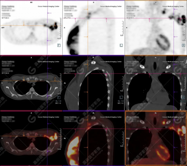 PET/CT病例（3）：別因害羞不願就診而延誤診斷——青年乳腺癌