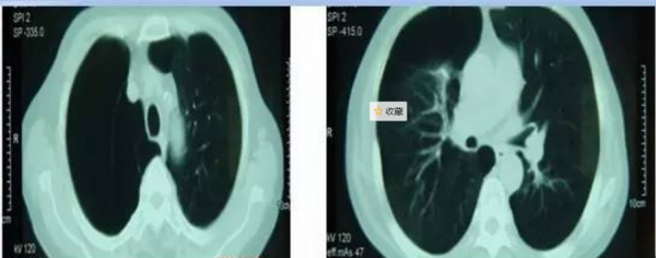 重度肺氣腫治不好只能等死？患者肺減容外科手術，讓你少走彎路