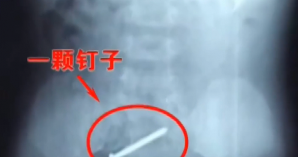 真實故事：陝西1歲幼童患怪病，身體長出鐵釘，醫生查明真相