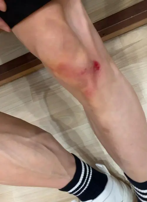 別把扭傷當小事 當心落下“內傷”