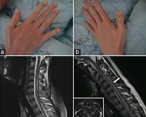 手部無力,上肢萎縮,手掌呈爪狀?醫生提醒:警惕“平山病” 手部無力,上肢萎縮,手掌呈爪狀?醫生提醒:警惕“平山病”