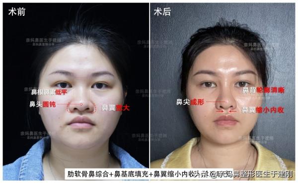 30歲姑娘，糾結10年不敢做鼻整形手術，如今卻突然來隆鼻變美