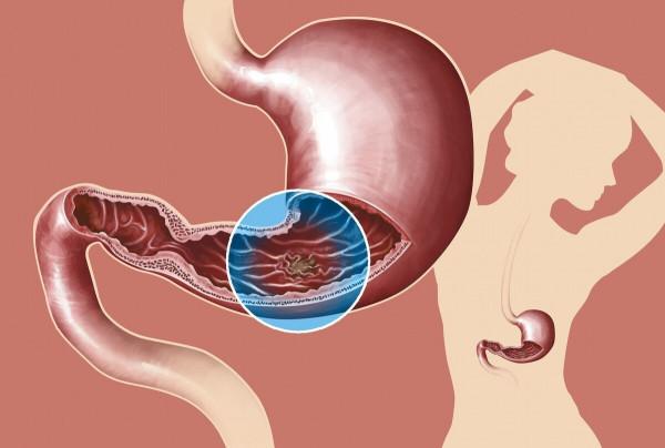 胃病不僅要用藥,主要在於養,養胃應該怎麼做? 胃病不僅要用藥,主要在於養,養胃應該怎麼做?