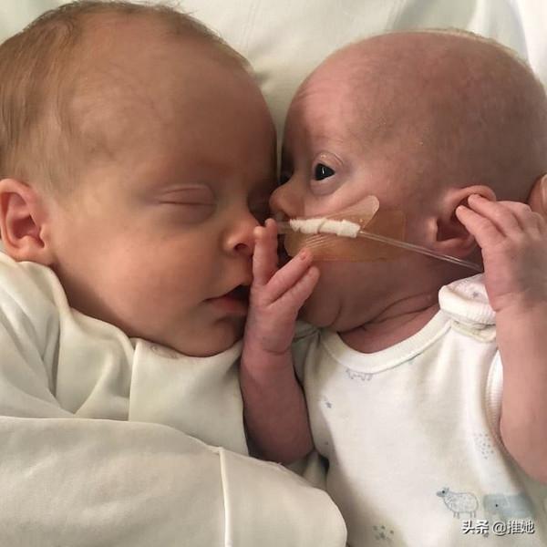 倆胎兒在媽媽子宮裡搶食，弟弟出生時不到1斤重，奇蹟般活了下來