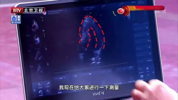2年沒複查,息肉變成癌!B超報告裡出現“這些字眼”可能危險了 2年沒複查,息肉變成癌!B超報告裡出現“這些字眼”可能危險了