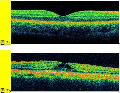 腦針見聞丨48歲女子飽受眼疾困擾，看東西像“蒙了一層紗”