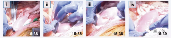 豬器官又立功了！移植豬腎給腦死亡病人，23分鐘後成功產生尿液