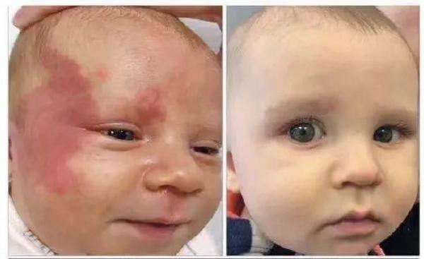 困擾爸媽的難題,小孩出現鮮紅斑痣該咋辦?難道與飲食有關? 困擾爸媽的難題,小孩出現鮮紅斑痣該咋辦?難道與飲食有關?