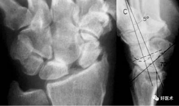 贊！腕關節X線高畫質解剖+腕骨脫位典型病例