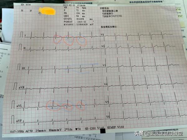 長期高血壓不控制真的會傷你的心，典型病例分享