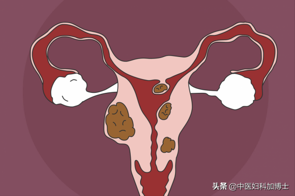 肌瘤大又不敢動手術？醫生：中醫這樣調理，體質變好，瘤消得更快
