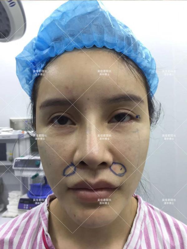 32歲姑娘小拉皮術後7個半月，變得年輕又精緻，前後反差很大