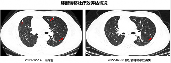 晚期HER2突變肺腺癌：後線吡咯替尼療效神奇