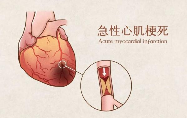 博士健康課丨天冷心梗高發!胸痛無小事,千萬不要忍 博士健康課丨天冷心梗高發!胸痛無小事,千萬不要忍