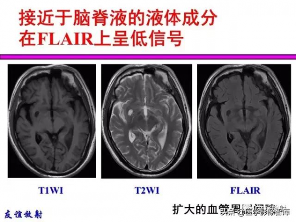 臨床MRI訊號分析基礎：常規序列及DWI序列
