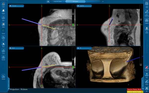 腋窩下開口兩釐米切癌保乳，精準導航下乳腺也能做腔鏡手術