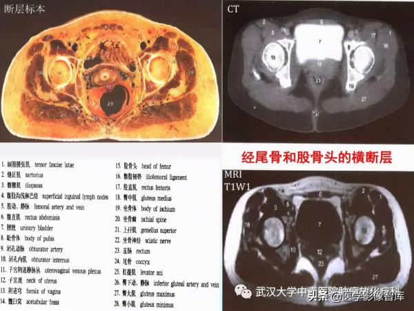 CT斷層解剖圖譜最全總結「推薦收藏」 CT斷層解剖圖譜最全總結「推薦收藏」