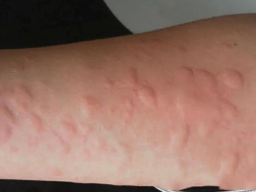 新手寶媽-產後蕁麻疹的困擾怎麼辦？