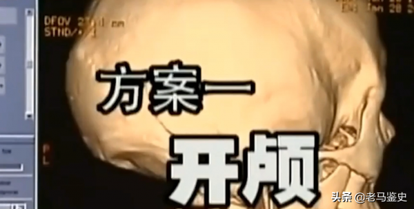 雲南30歲男子口臭駭人，只因&quot;腦中藏10釐米長刀&quot;，最終結局如何？