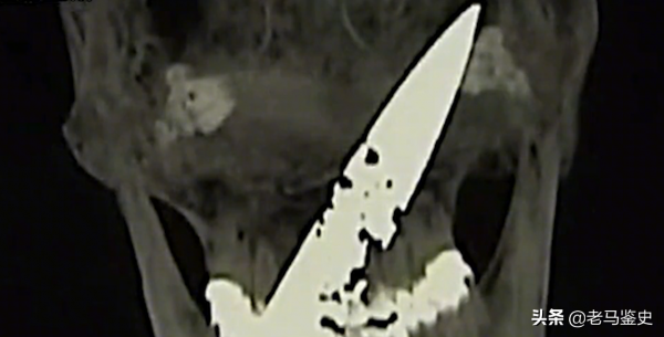 雲南30歲男子口臭駭人，只因&quot;腦中藏10釐米長刀&quot;，最終結局如何？