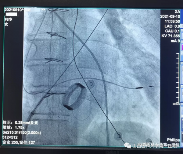山西醫科大學第一醫院完成山西省首例經房間隔左室心內膜起搏