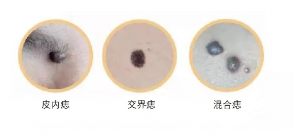 身上長的痣，到底要不要祛除？