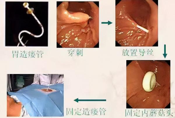 無法正常進食，經皮內鏡下胃造瘻術（PEG）幫助患者好好吃頓飯