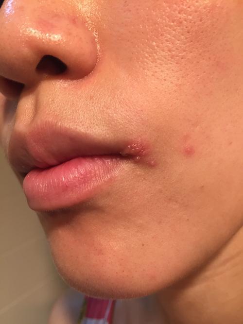 嘴巴周圍時不時出現“幾個水泡”，是什麼原因呢？不妨來看一下
